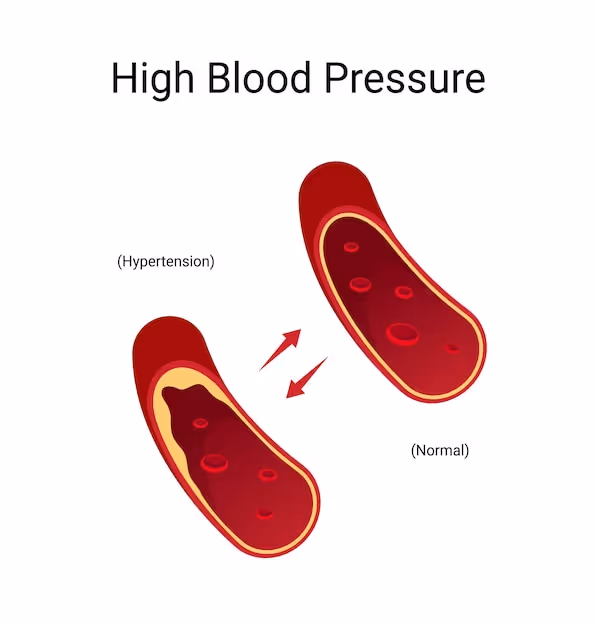 Premium Vector | Infographics high blood pressure hypertension