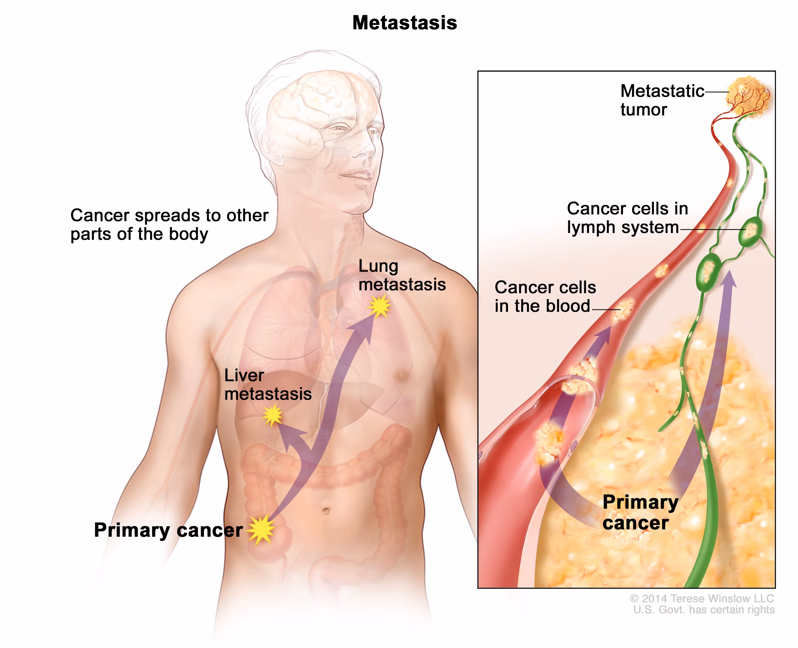 Definition of metastasis - NCI Dictionary of Cancer Terms - NCI