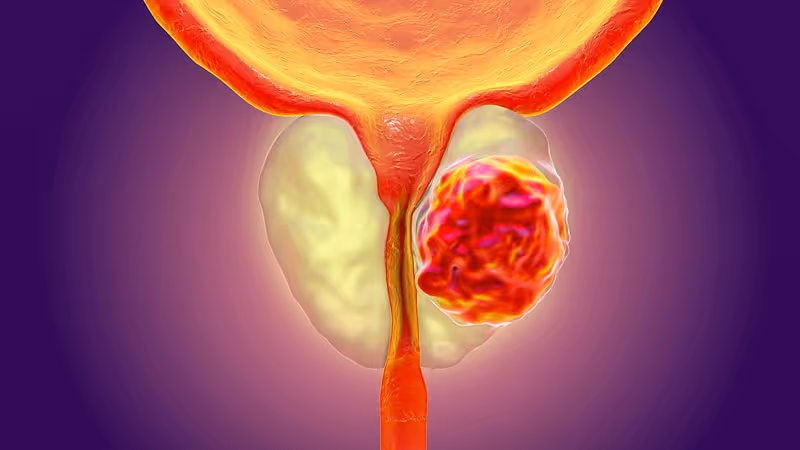 Prostate Cancer & PSA Calculators, Check Your Cancer Risk In 2 Minutes