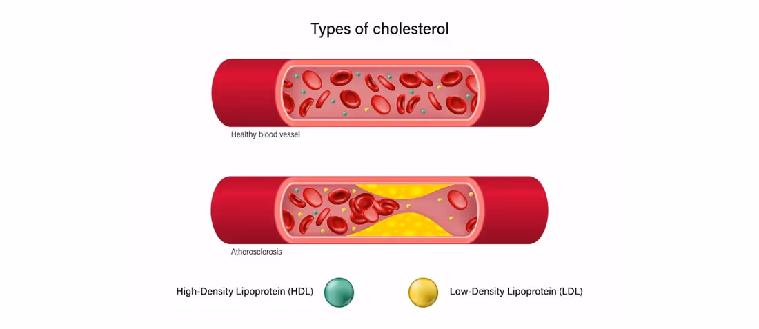 HDL vs LDL: What is the Difference Between HDL and LDL Cholesterol? – Lets Moderate