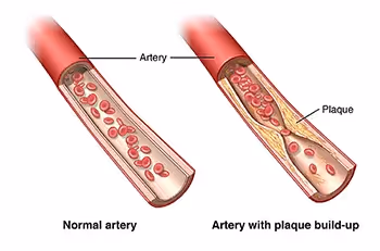 Atherosclerosis | Johns Hopkins Medicine
