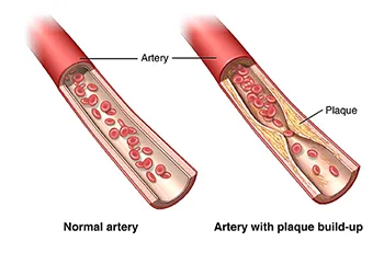 Atherosclerosis | Johns Hopkins Medicine