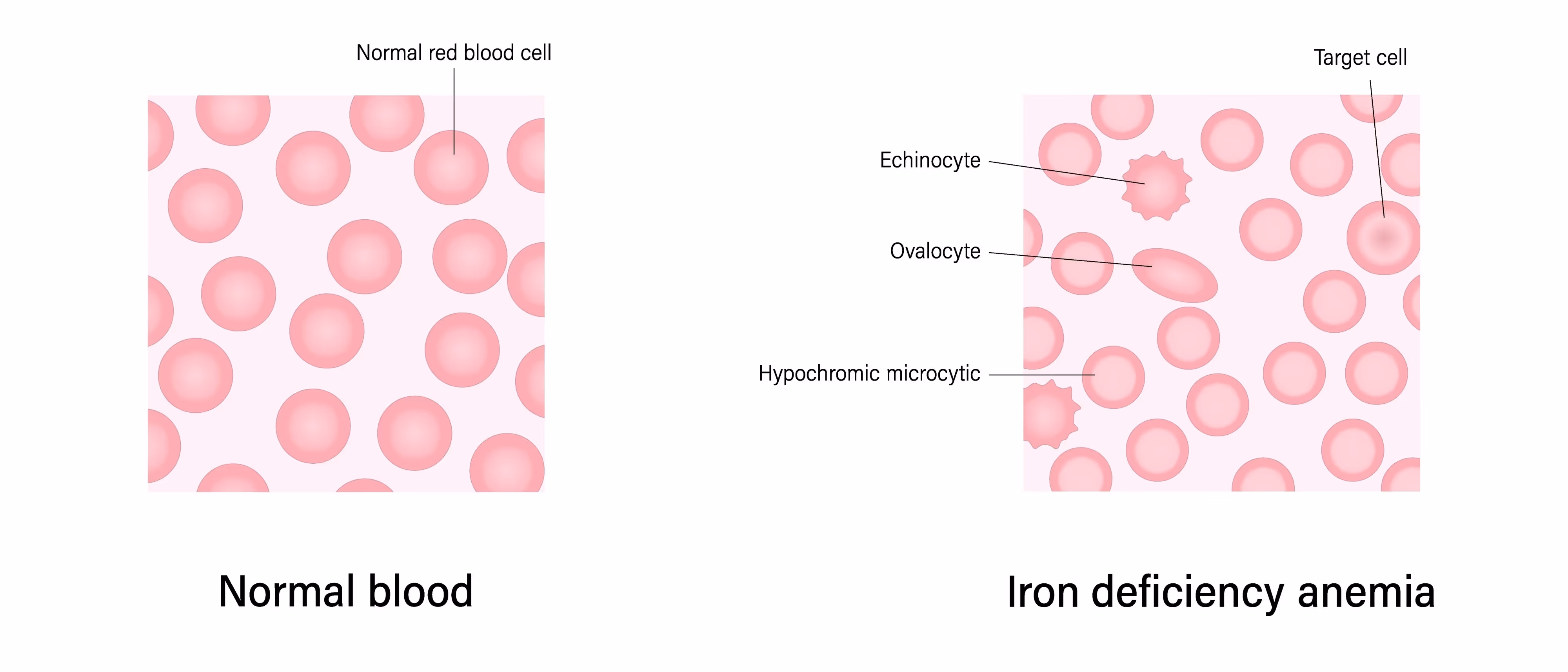Image of healthy red blood cells vs iron-deficient cells