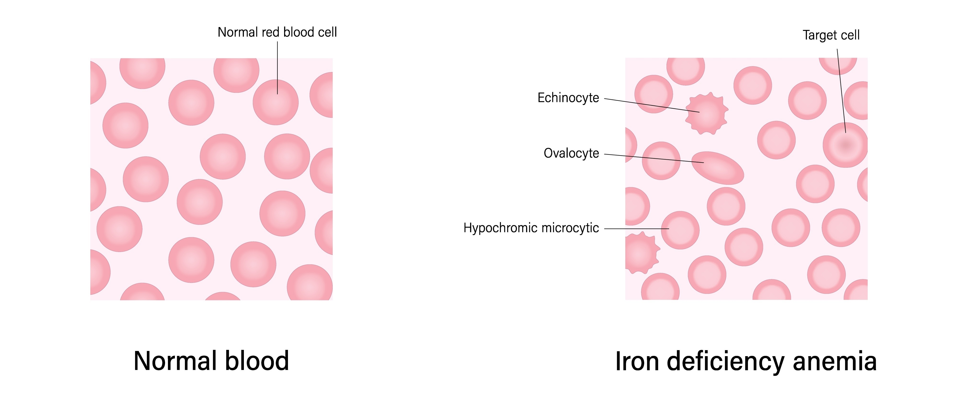 Image of healthy red blood cells vs iron-deficient cells 