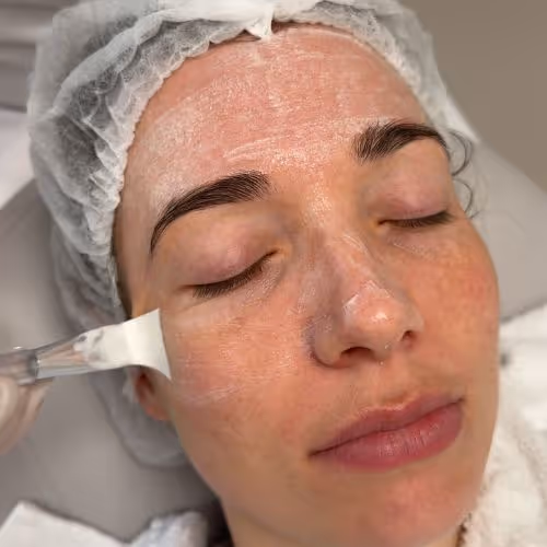 In de herfst en winter pakken we melasma actiever aan met behandelingen zoals de Mela Peel Forte, speciaal ontwikkeld voor melasma.