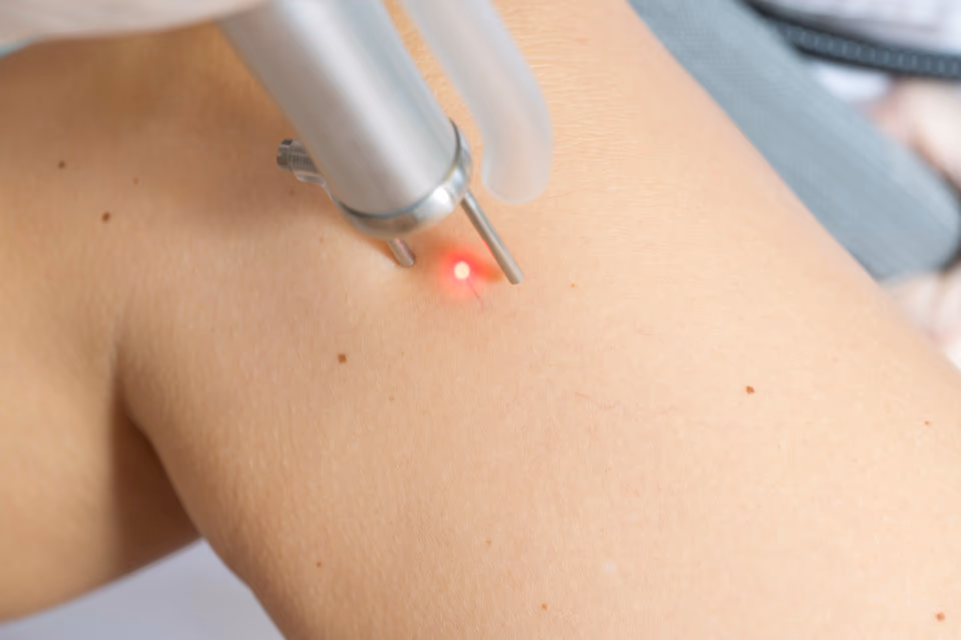 Wat is de beste behandeling voor storende beenvaatjes?