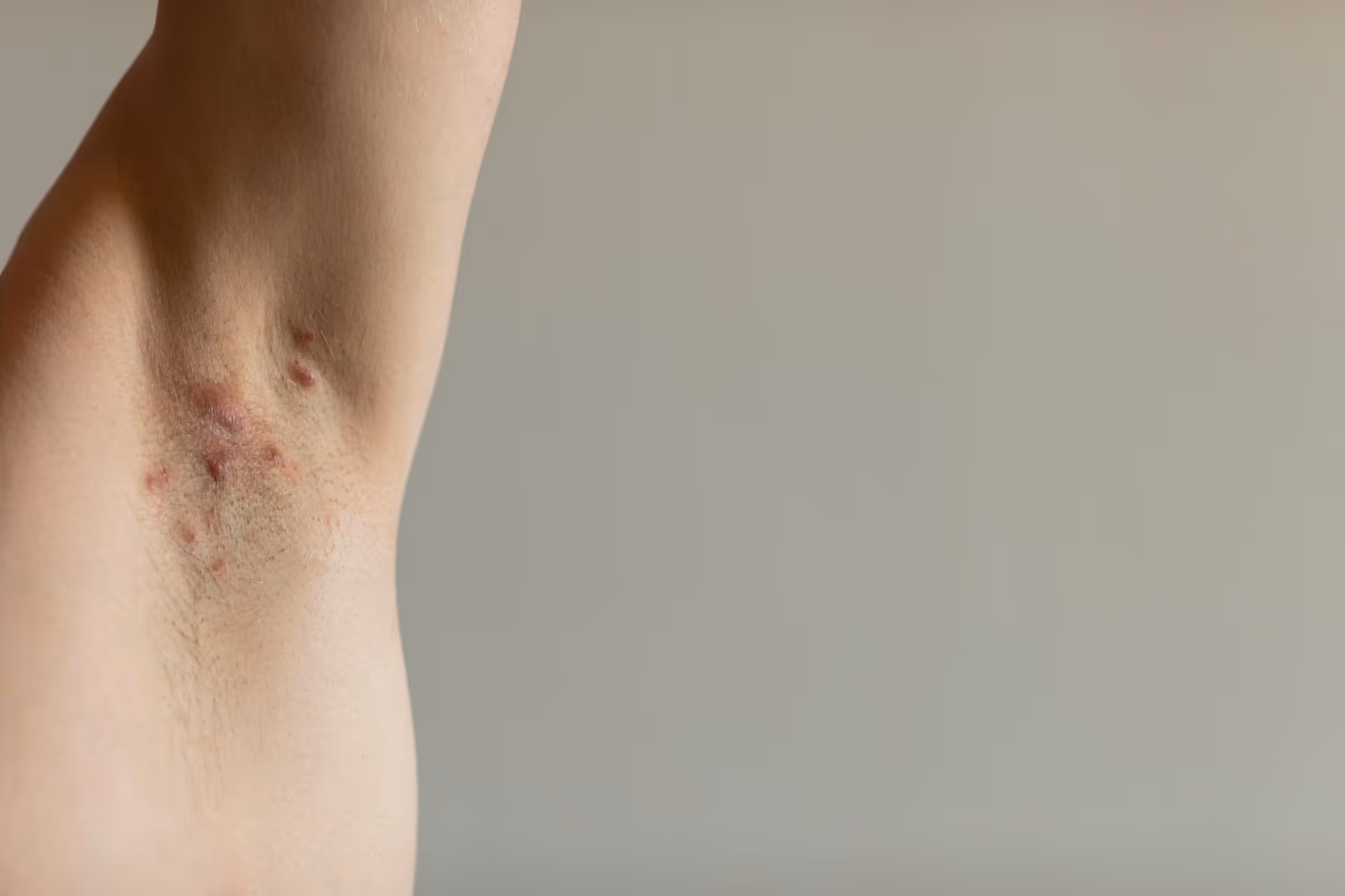 Laser ontharen bij hidradenitis suppurativa