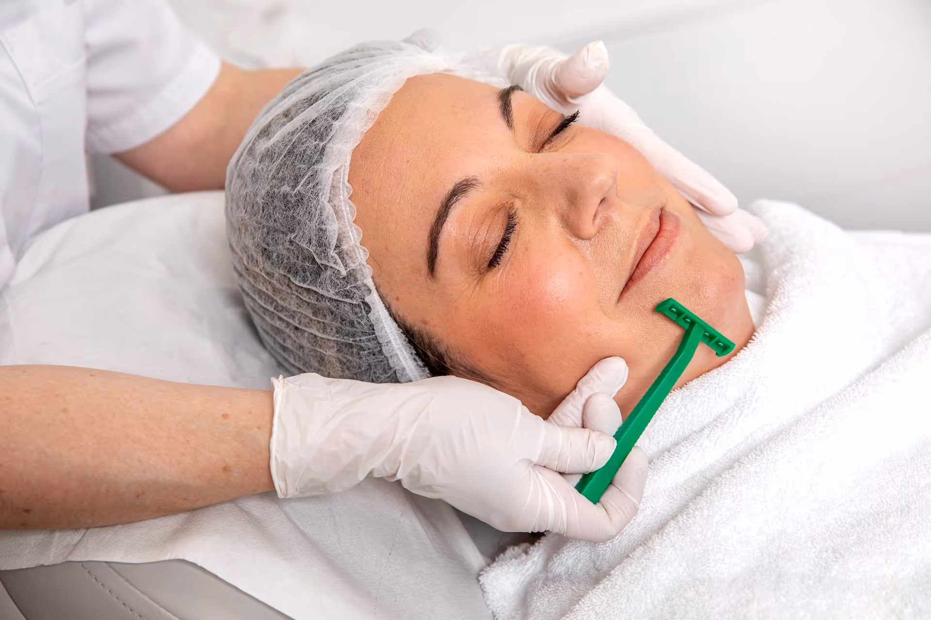 Laser ontharen bij PCOS