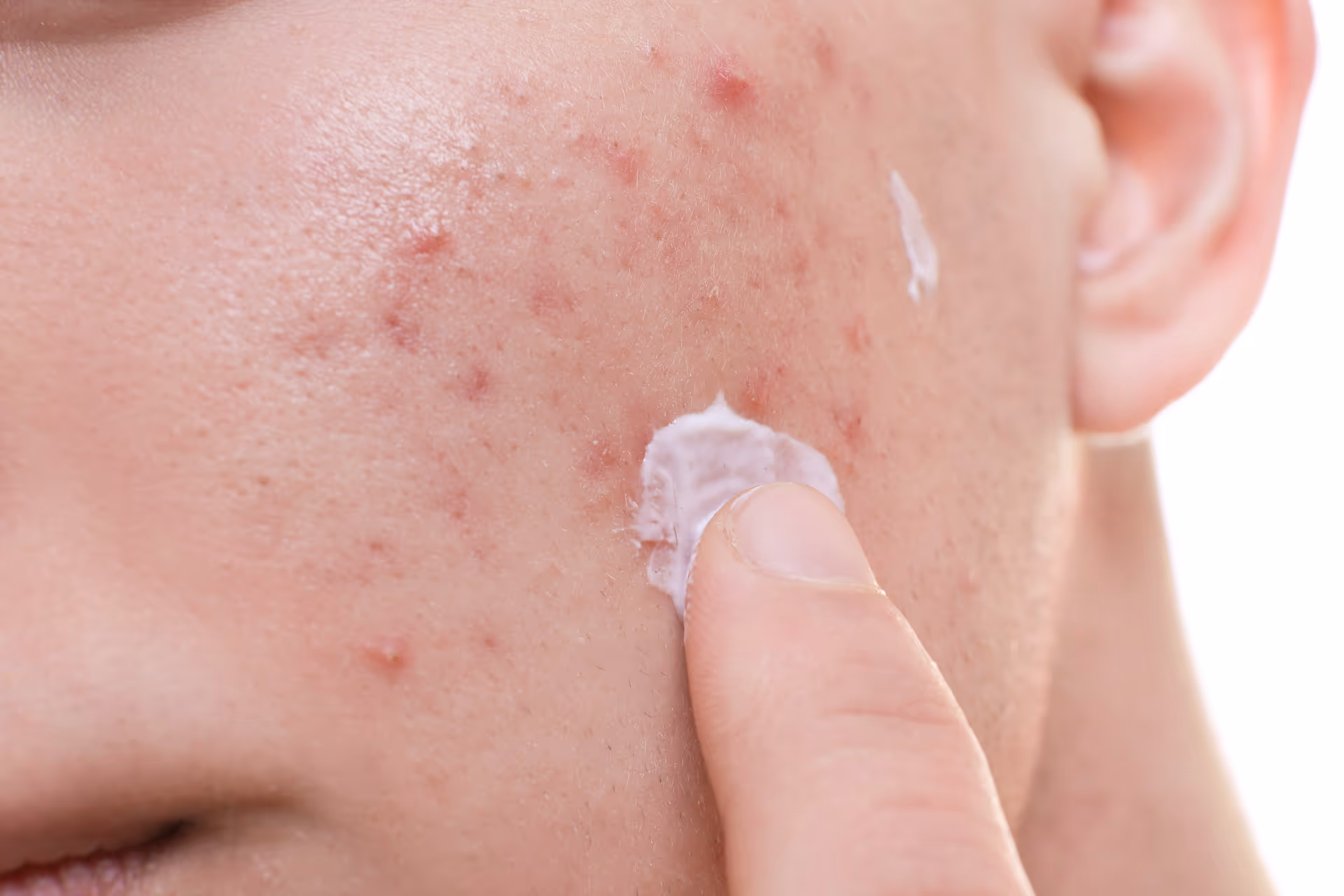 Acne in het gezicht Laserkliniek Zwolle
