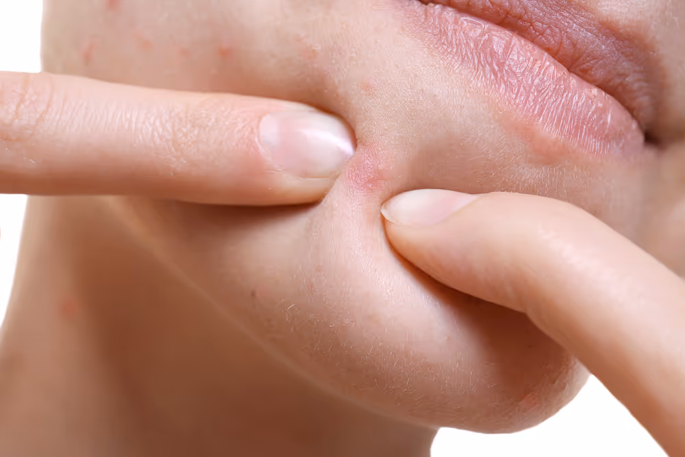 Heb jij last van acne? Laserkliniek Zwolle