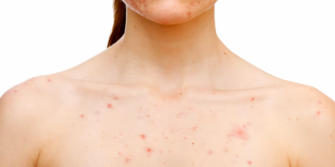 Acne op de borst komt vaker voor. 