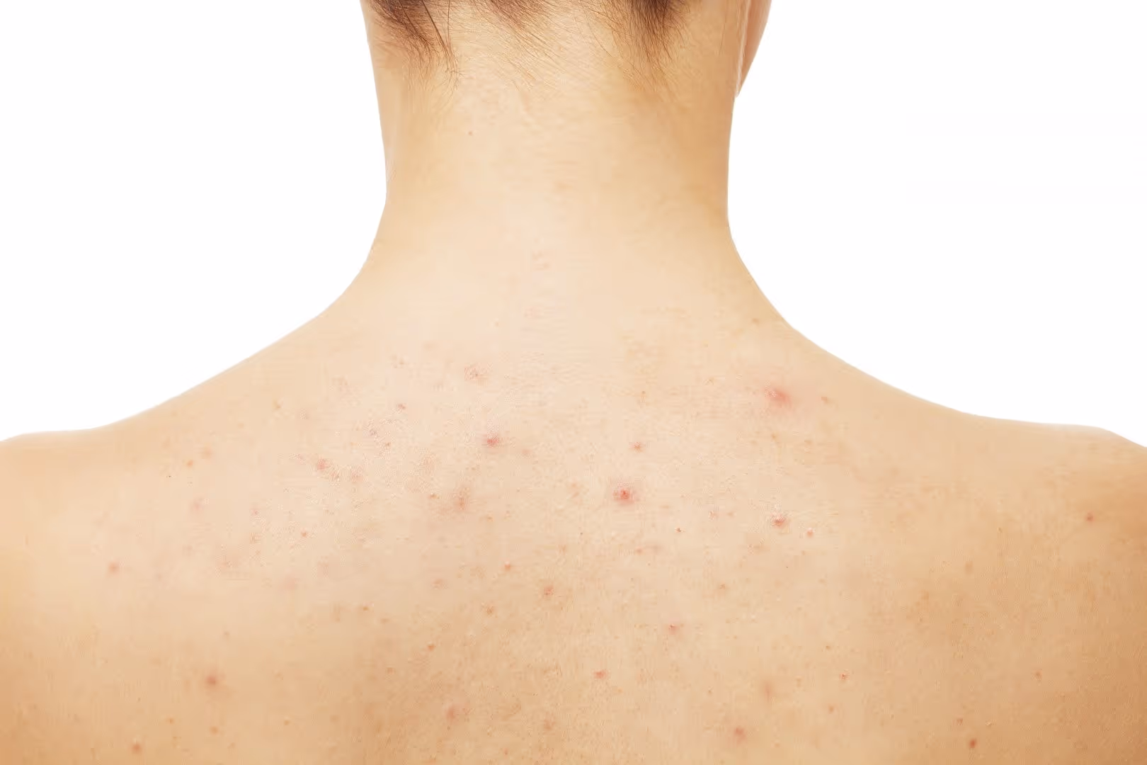 Acne op de schouders laten behandelen bij Laserkliniek Zwolle
