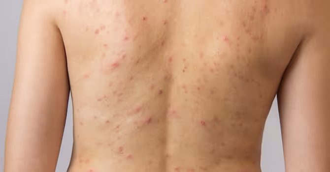 Last van acne op je rug? Raadpleeg Laserkliniek Zwolle