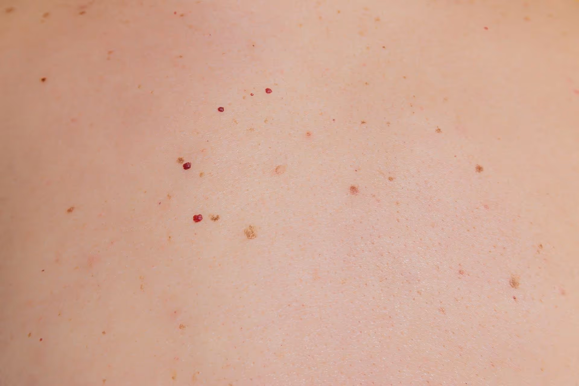 Bloedblaasjes behandelen met de vaatlaser bij Laserkliniek Zwolle