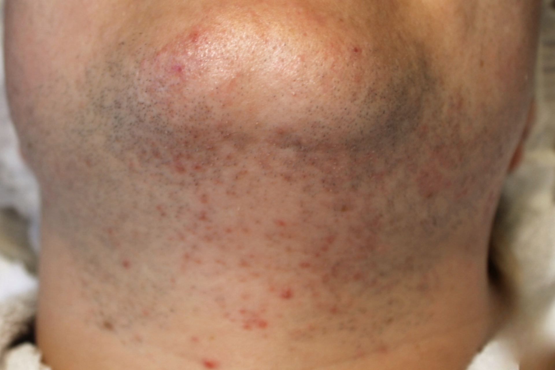 Haargroei gezicht laten behandelen met laser