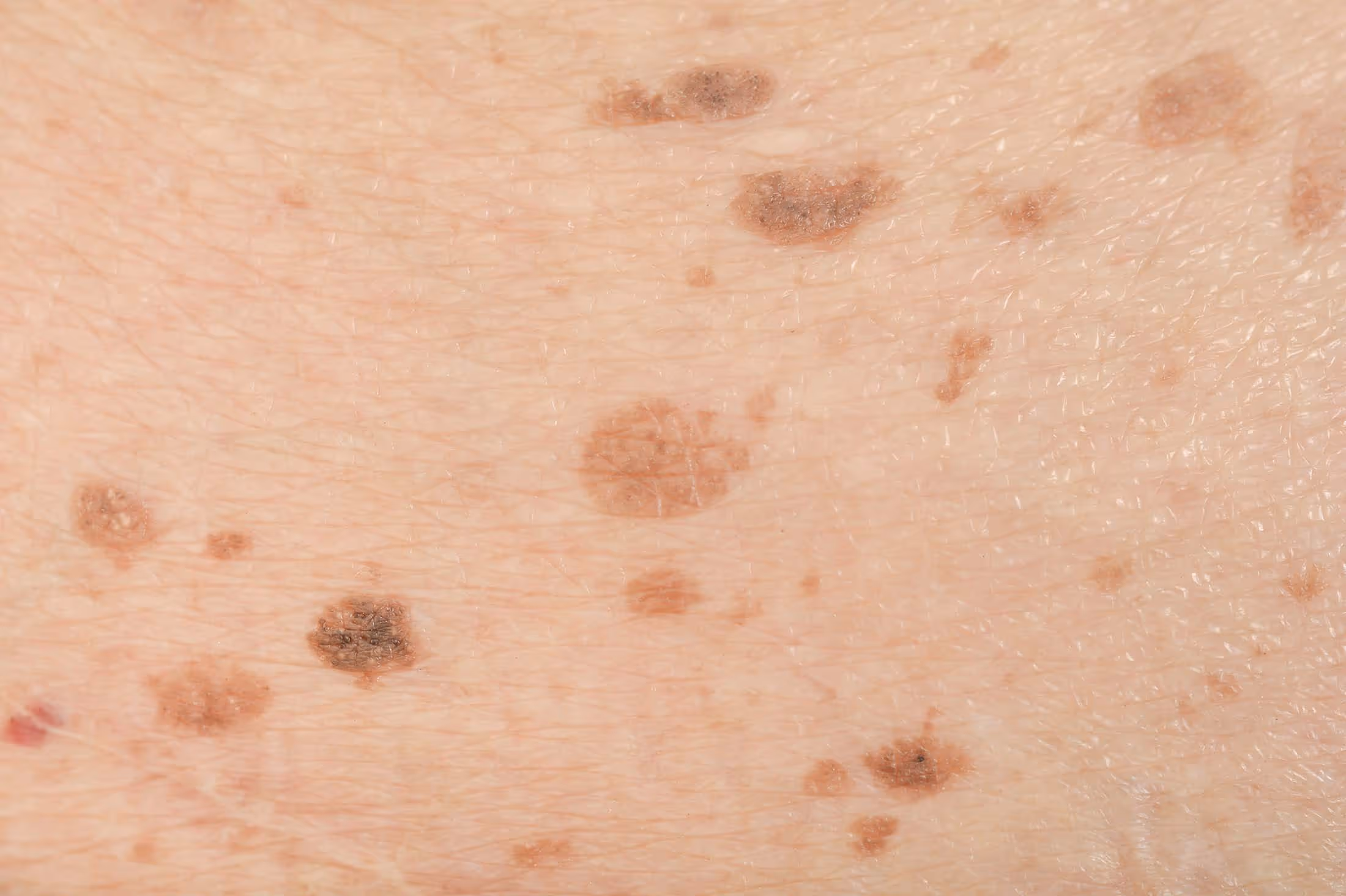 Ouderdomsvlekken op het lichaam laten verwijderen bij Laserkliniek Zwolle