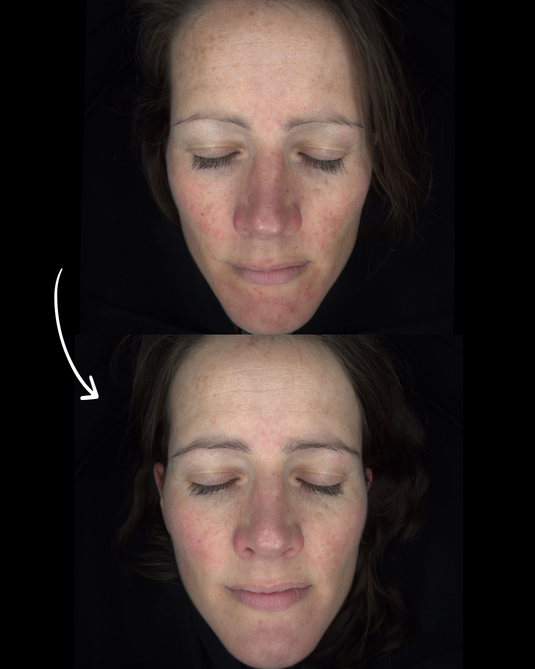 Voor en na melasma behandeling met vitamine C