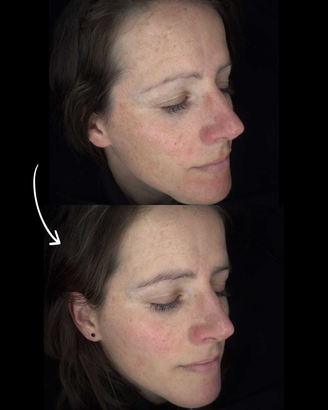 Melasma laten behandelen in Zwolle