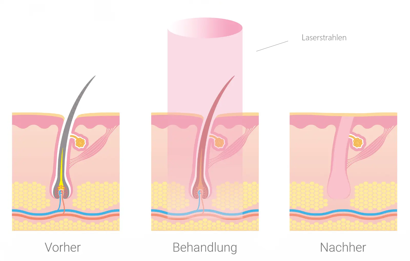 Illustration der Laser-Haarentfernung mit drei Hautquerschnitten: Vorher zeigt einen intakten Haarfollikel, Behandlung zeigt Laserstrahlen, die auf den Haarfollikel wirken, Nachher zeigt eine haarfreie Hautstelle.