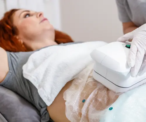 Frau liegt entspannt auf der Liege, während eine Kryolipolyse-Behandlung am Bauch durchgeführt wird.