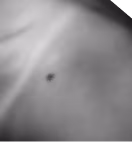 Male chest area during testosterone therapy consultation at Mar Max Medical