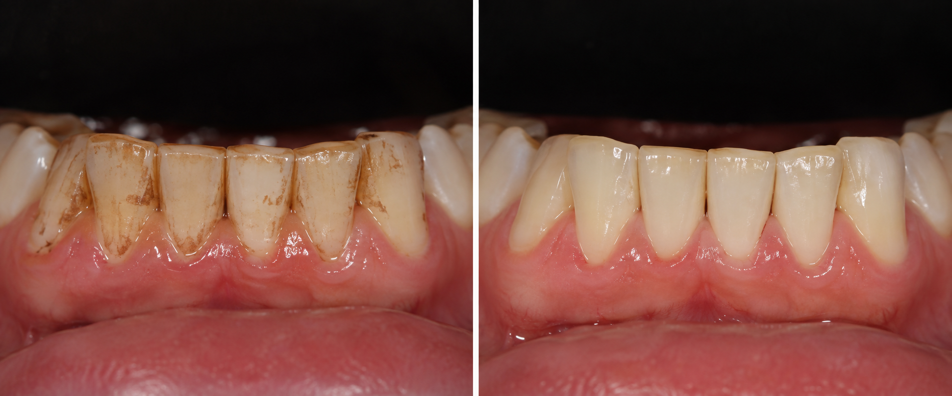 Illustrative before-and-after example of coffee and tea stain removal from lower front teeth