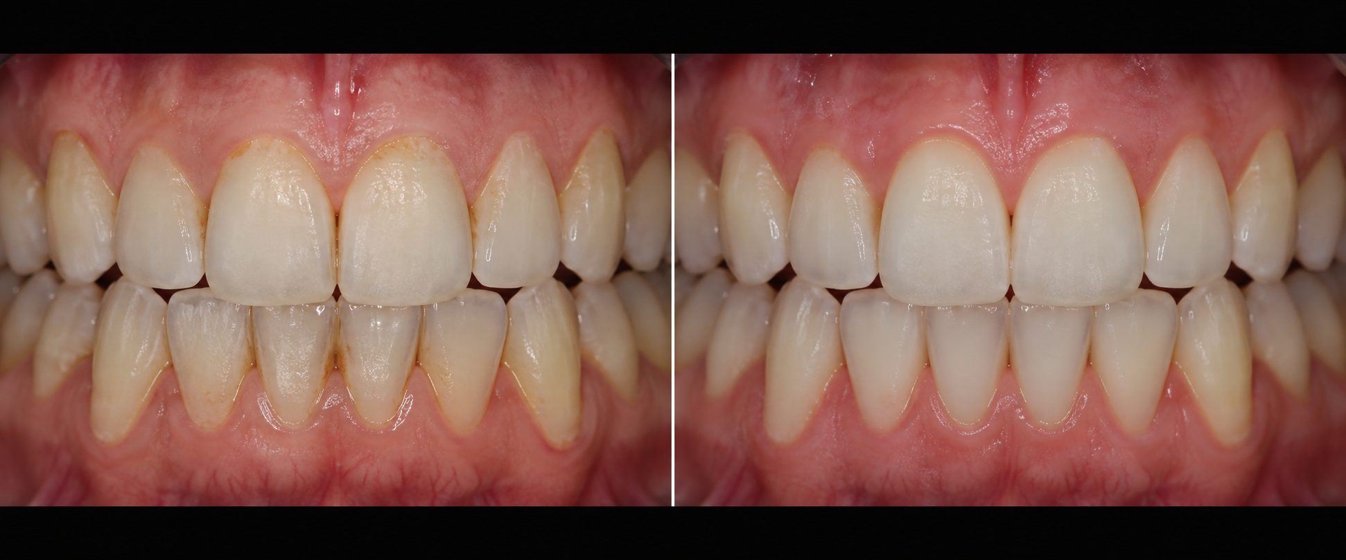 Illustrative before-and-after example of a routine dental hygiene maintenance clean