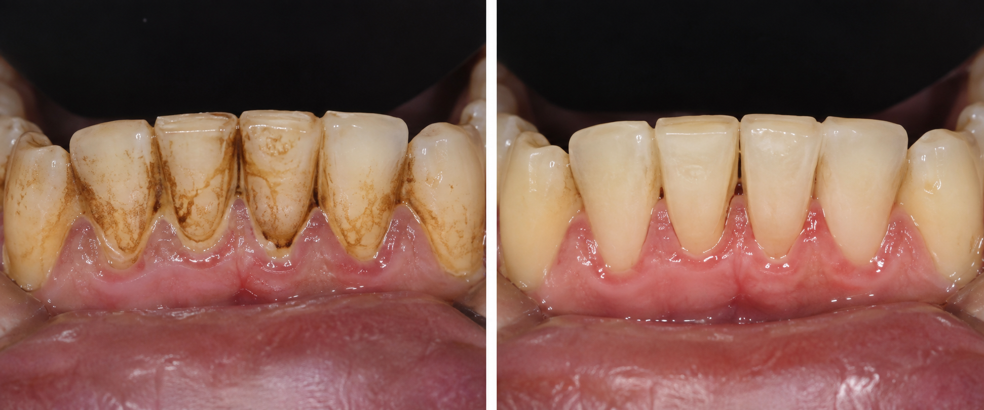 Illustrative before-and-after example of smoking-related surface stain removal