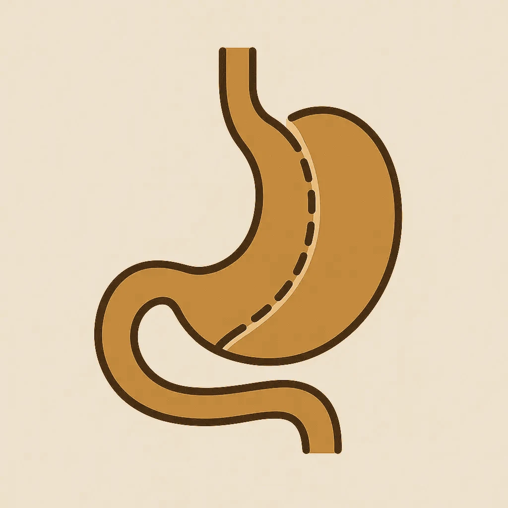 Gastric sleeve