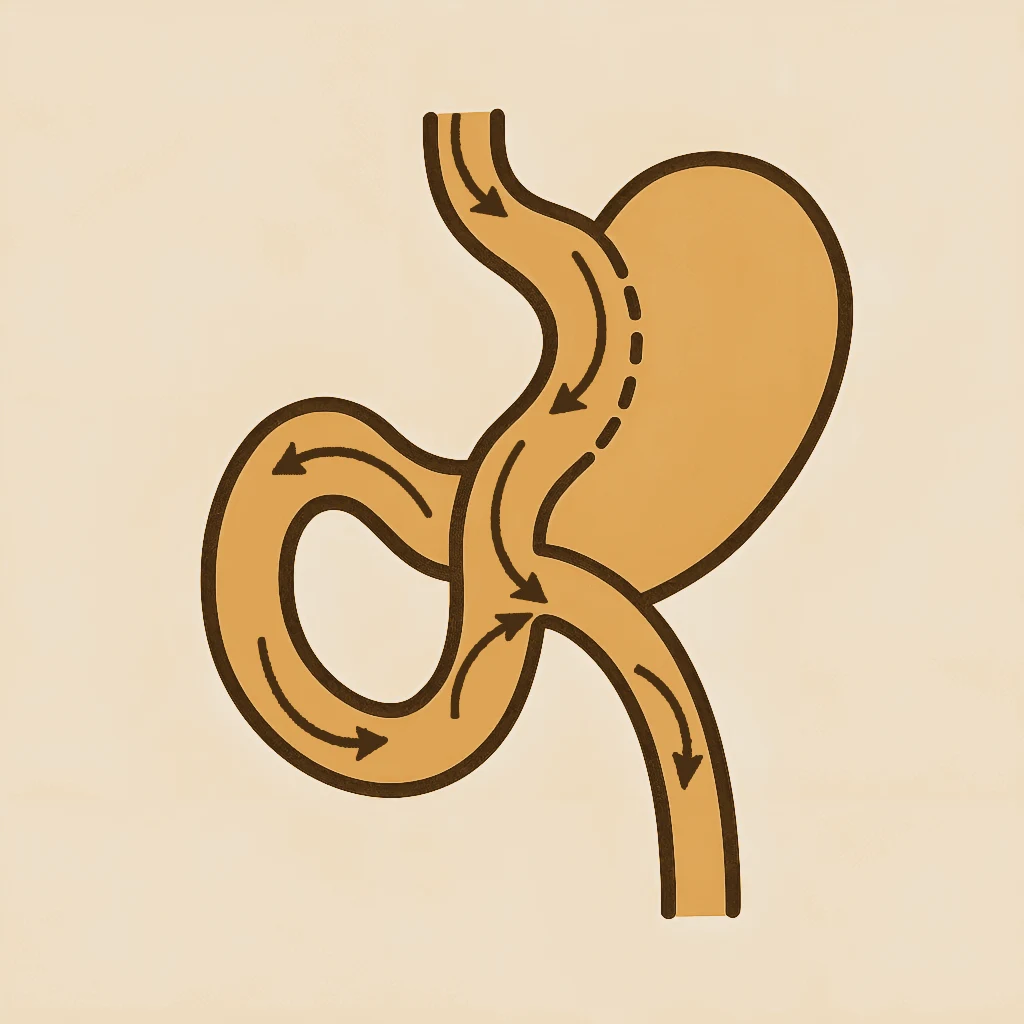 Mini gastric bypass