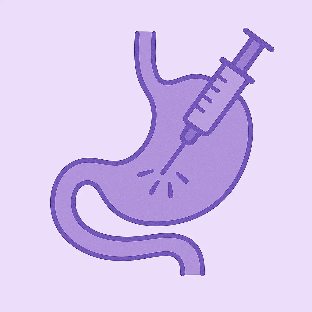 Ilustración del procedimiento de bótox gástrico que muestra una inyección en el estómago
