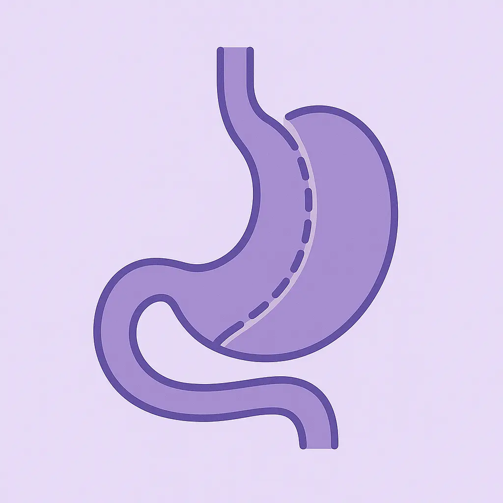 Illustration of sleeve gastrectomy showing the reduced sleeve-shaped stomach