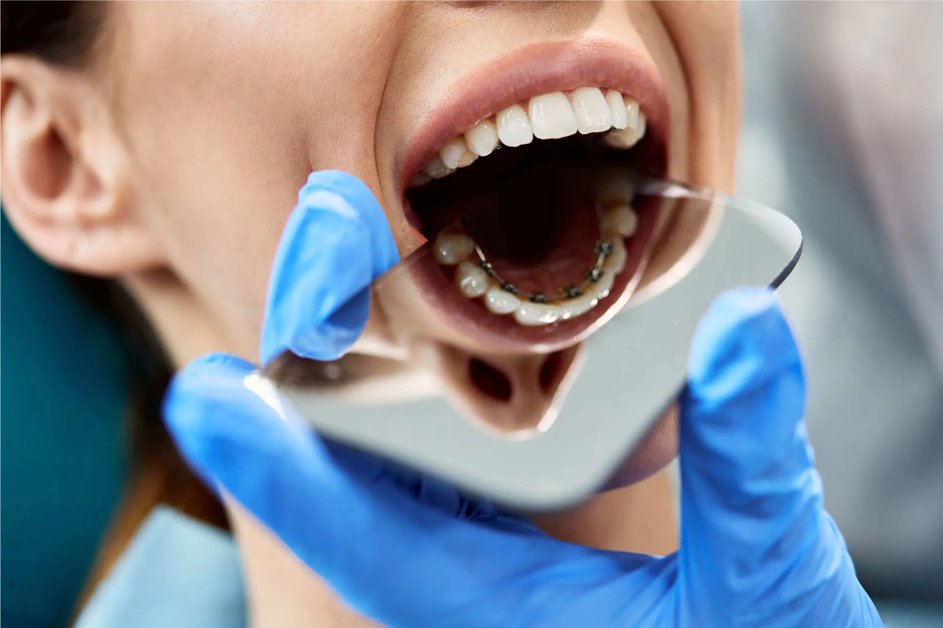 close-up-of-orthodontist-checking-lingual-braces