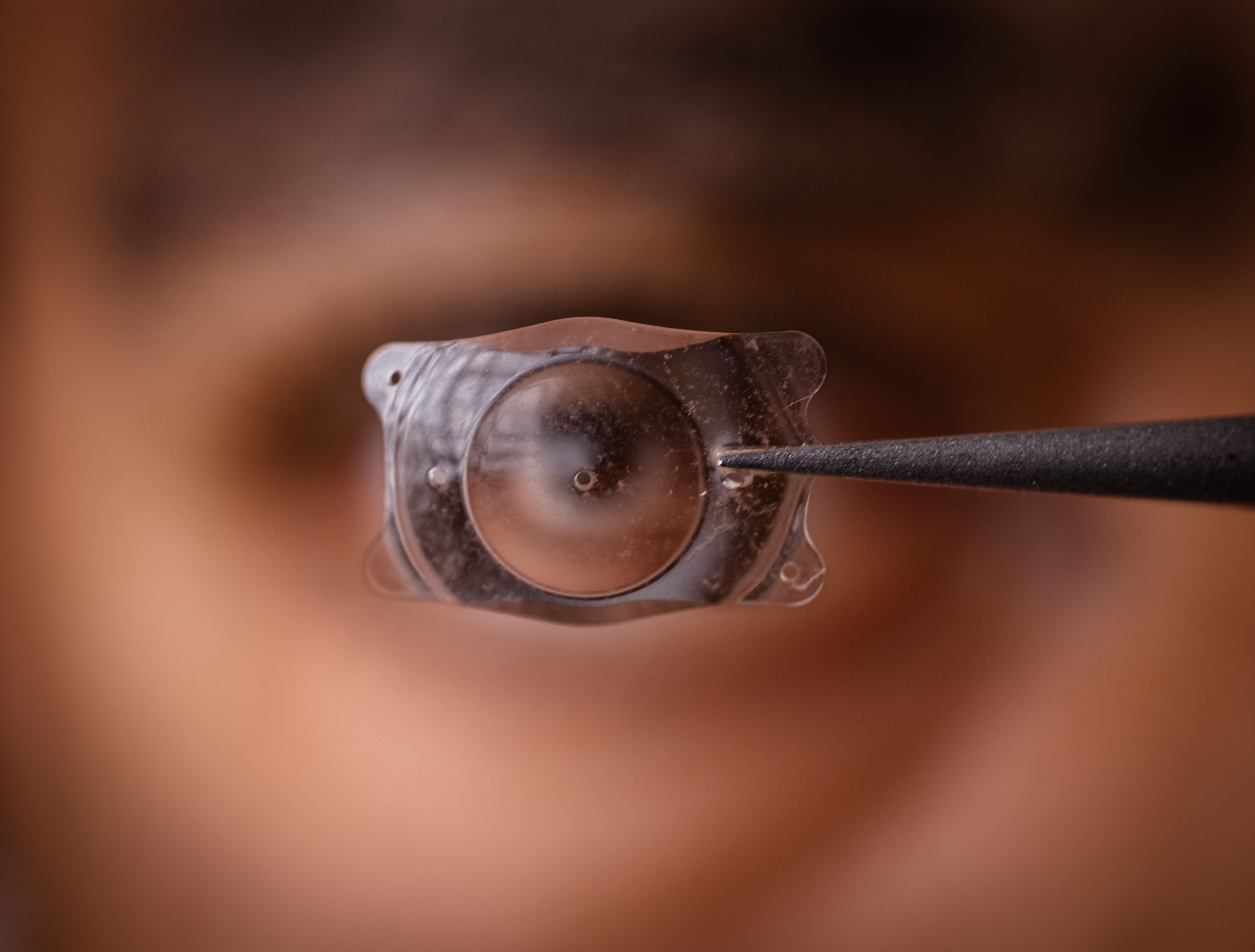 Chirurgie ICL par implants phaques