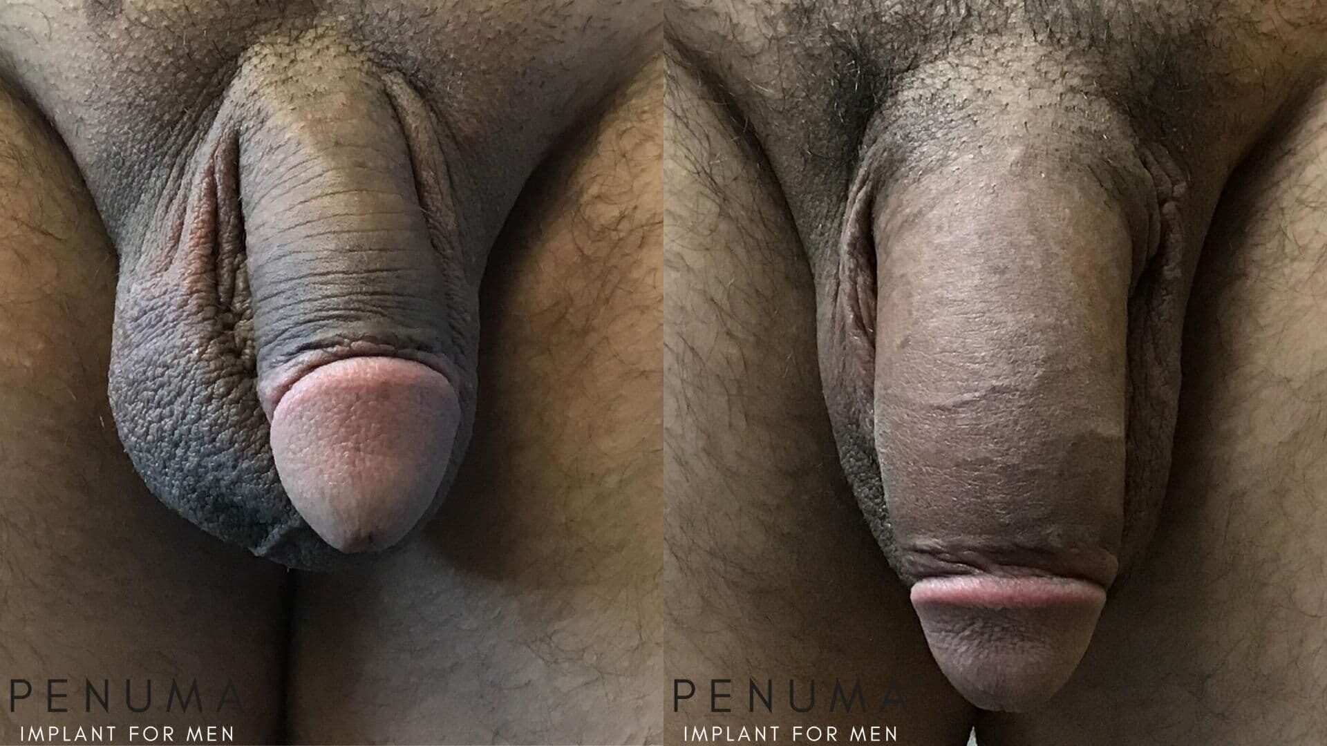 penis enlargement before and after