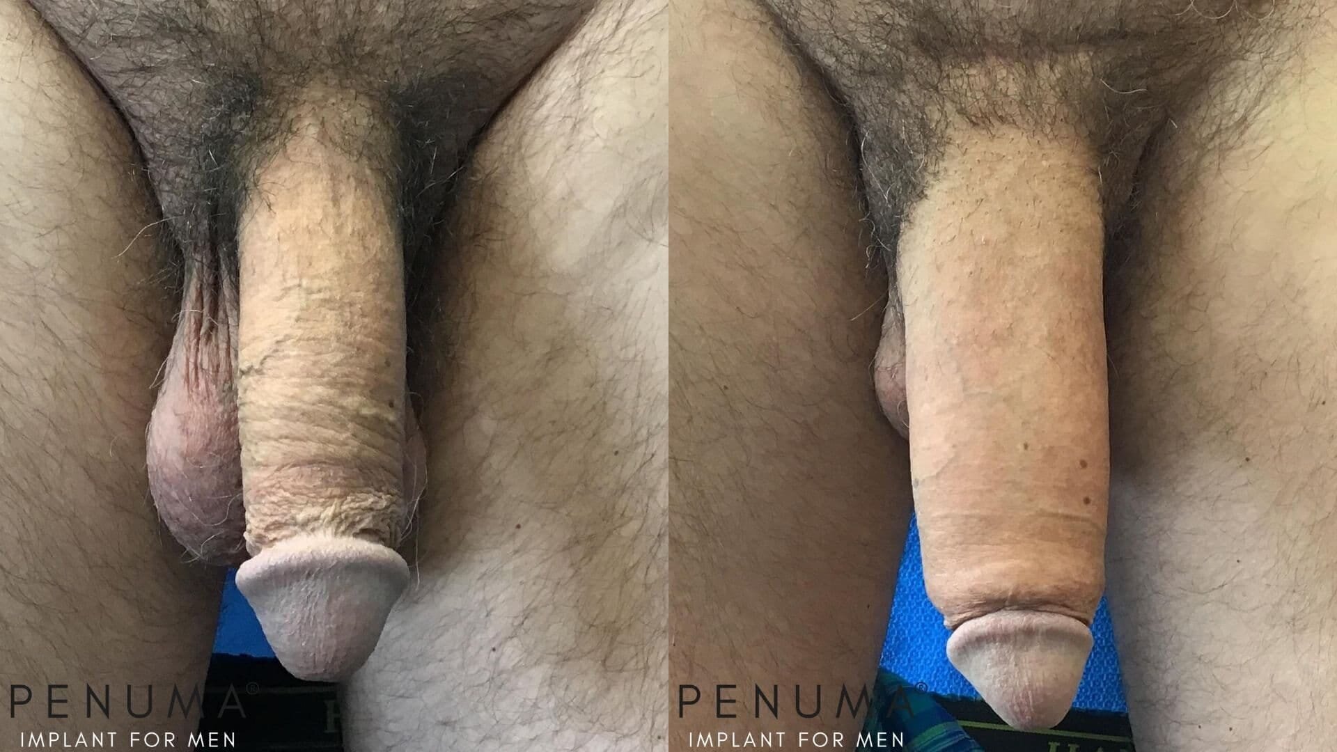 Himplant penile implant before and after