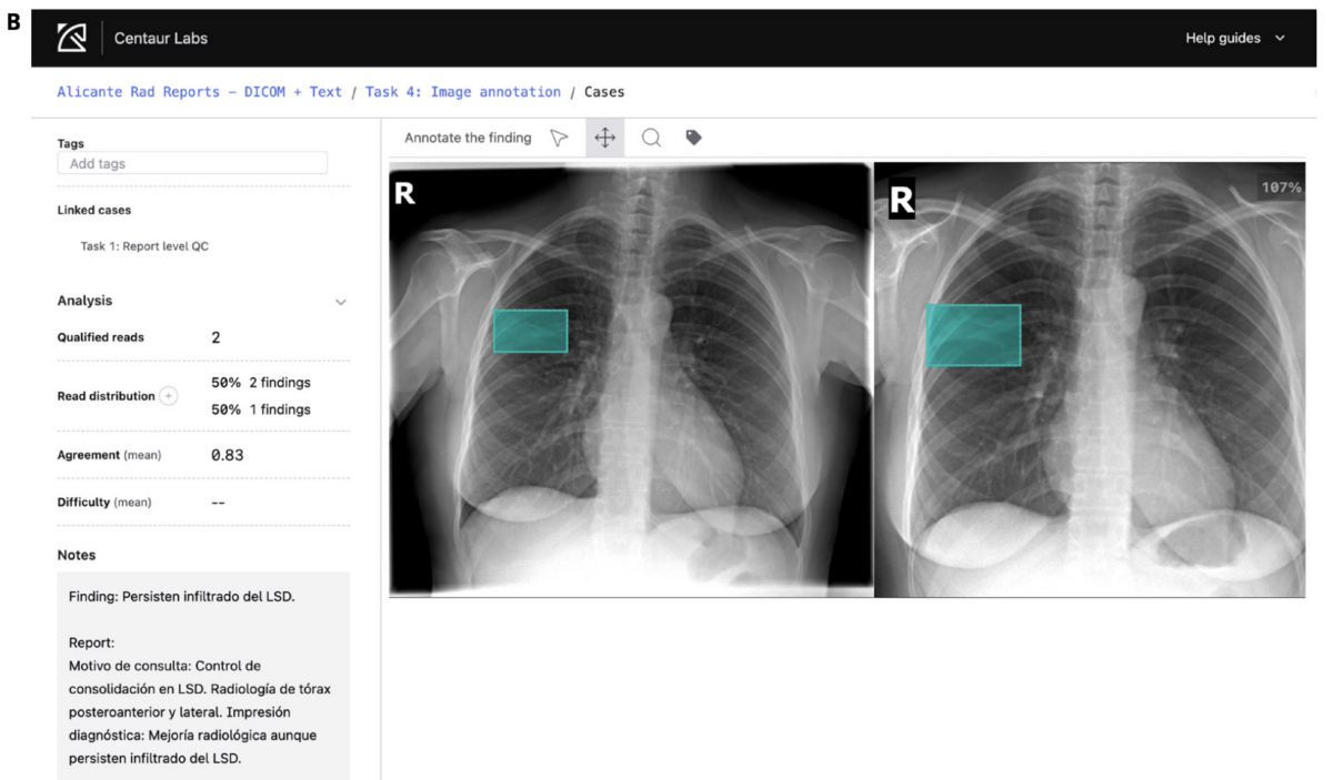 Chest X-ray interface showing AI-assisted annotation from Centaur Labs, with highlighted regions marking areas of interest for clinician review. Image source: NEJM AI, “Generalist Medical AI for Radiology,” 2025.