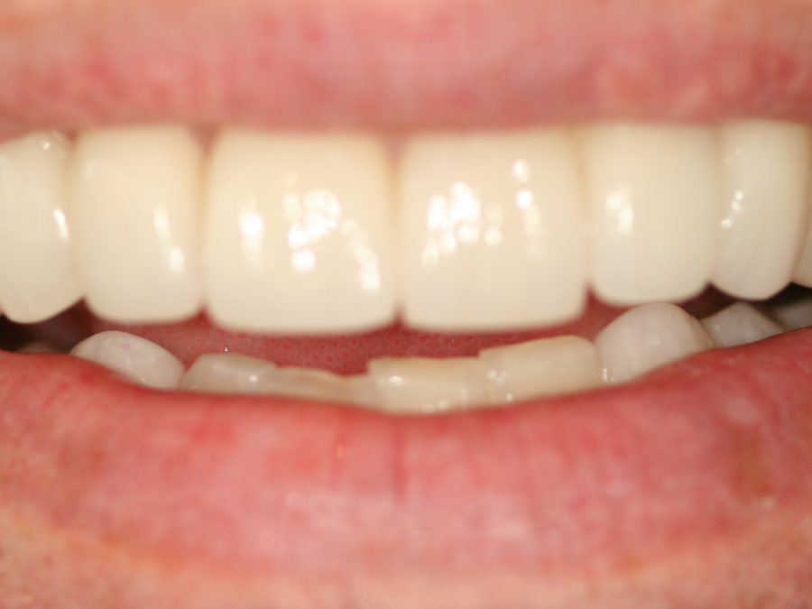 After same-day restoration