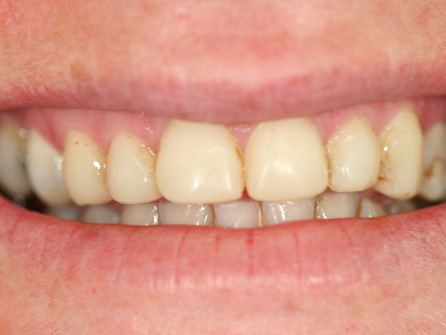 Before same-day restoration