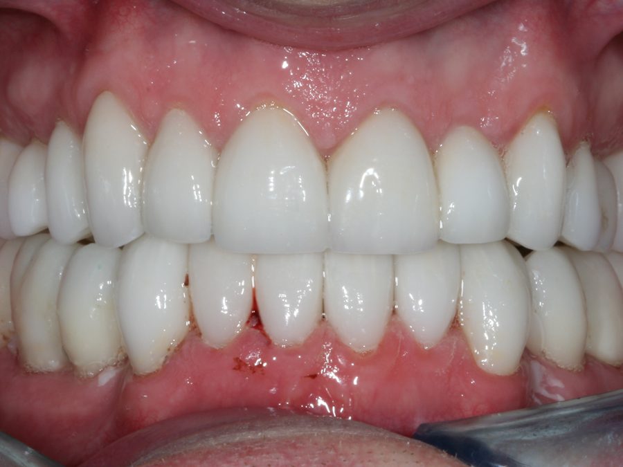 After same-day restoration