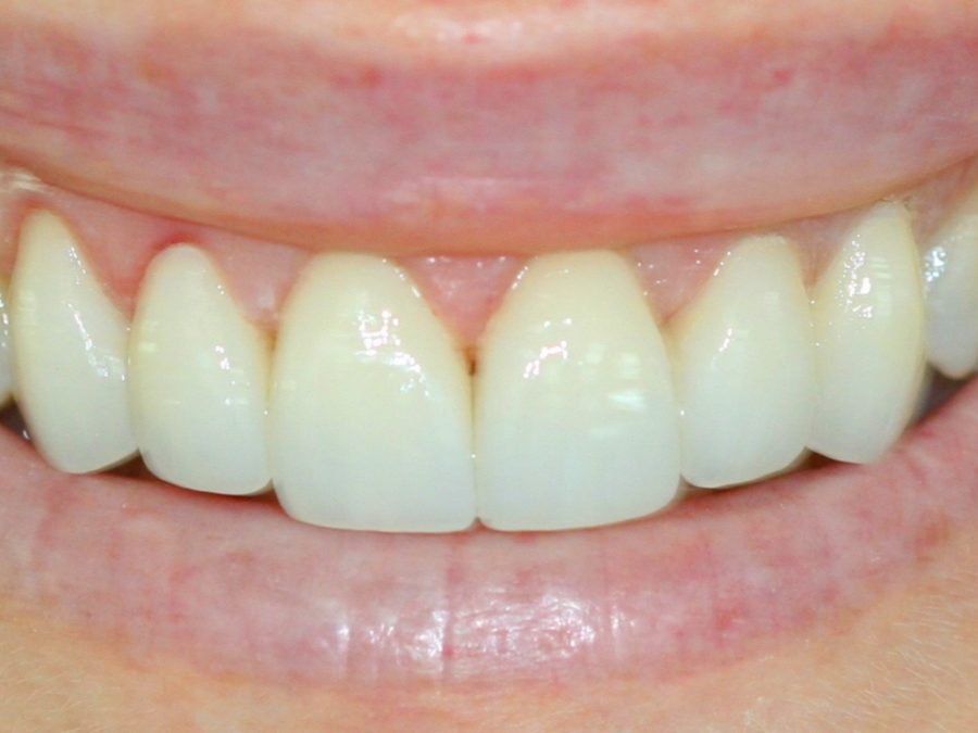 After same-day restoration