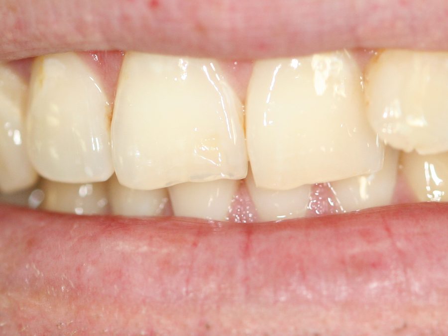 Before same-day restoration
