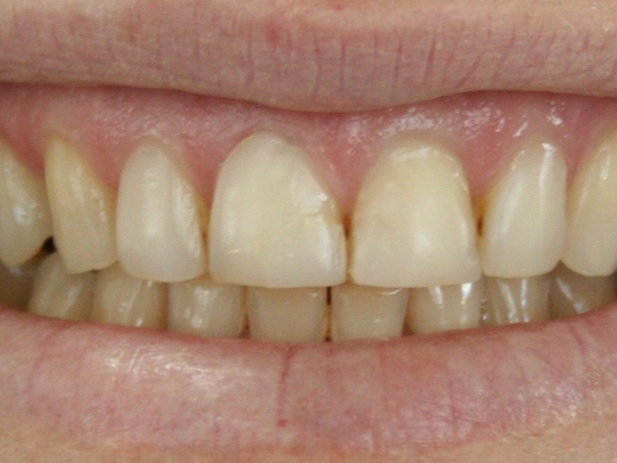Before same-day restoration