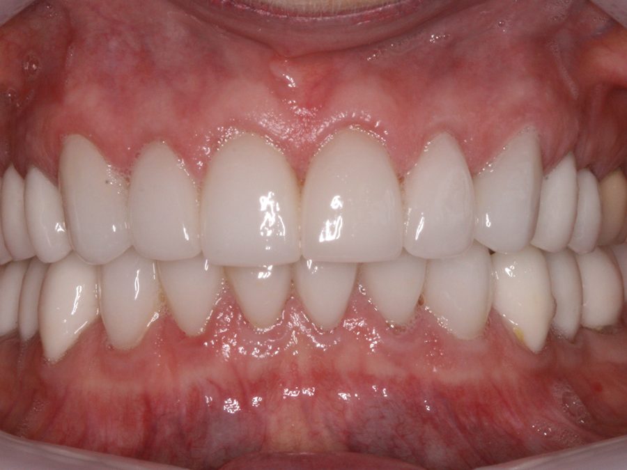After same-day restoration