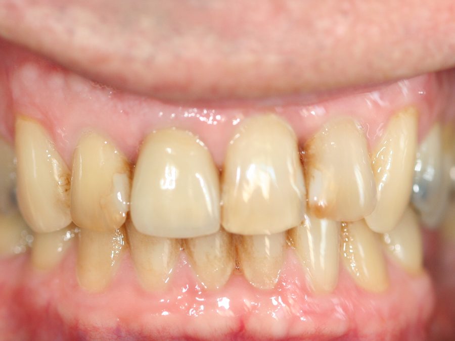 Before same-day restoration