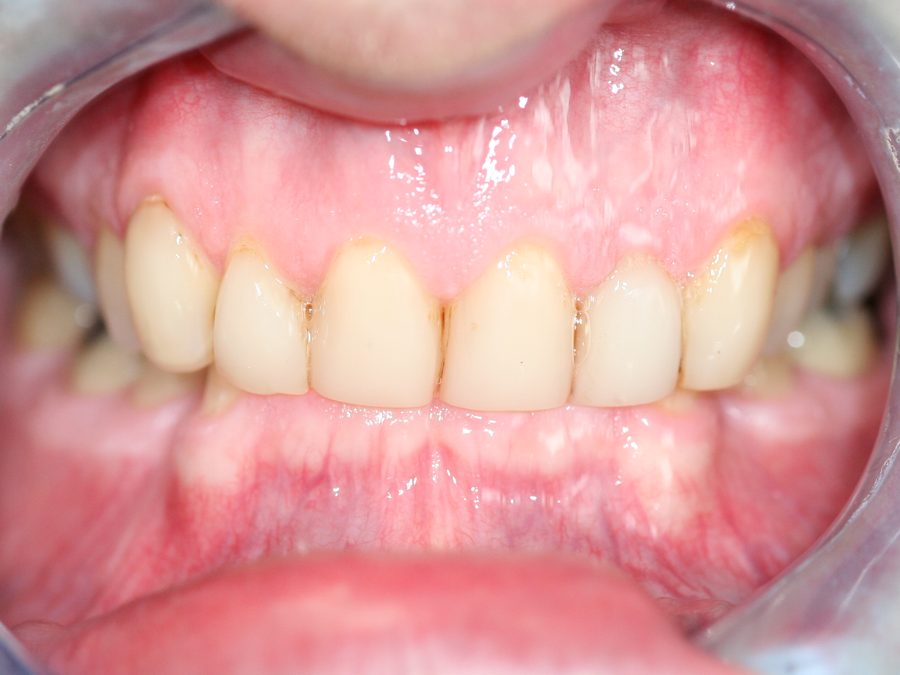 Before same-day restoration