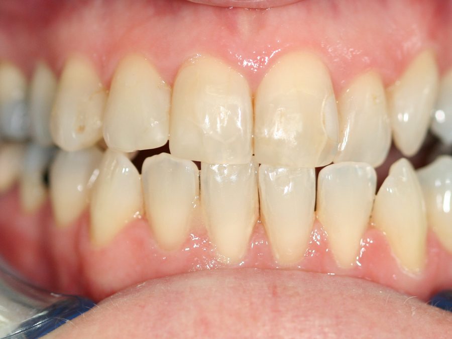 Before same-day restoration