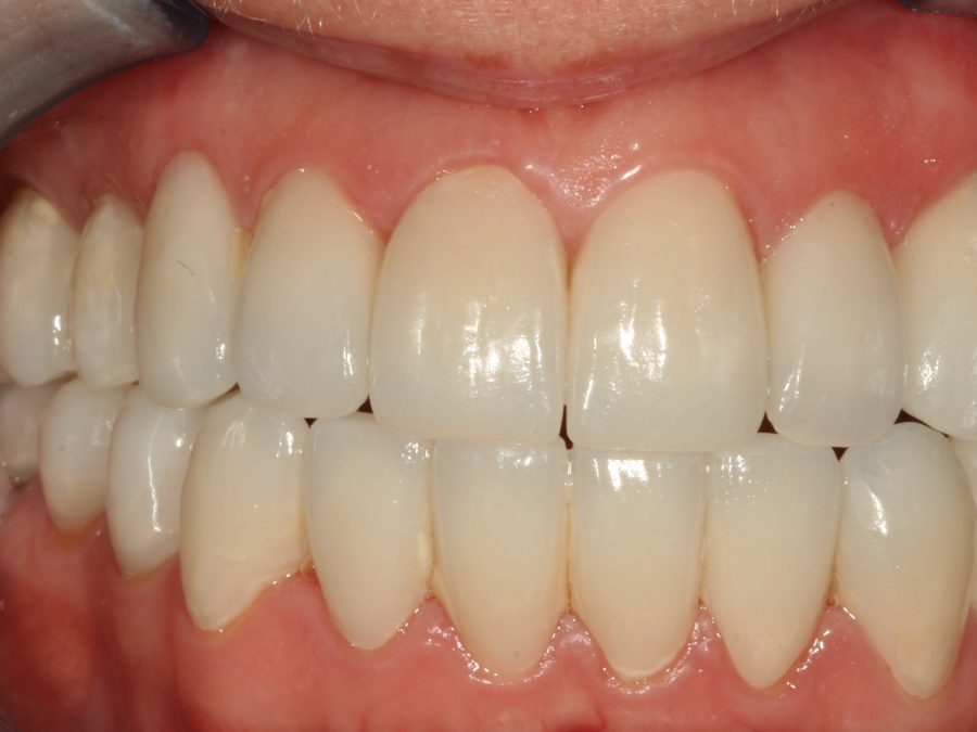 After same-day restoration