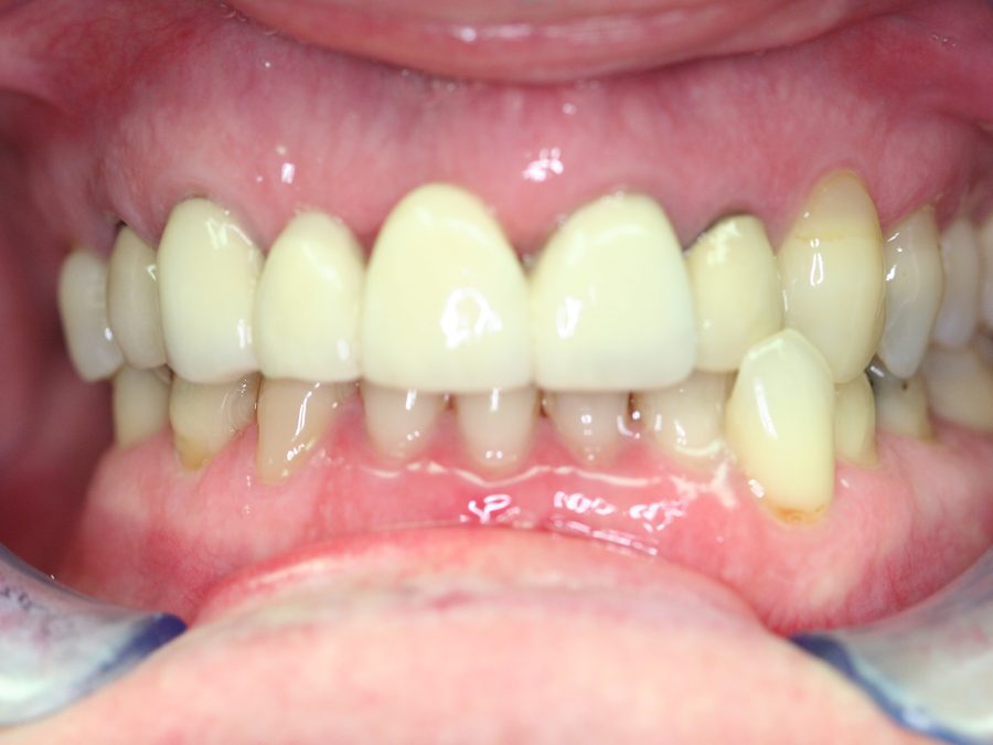 Before same-day restoration