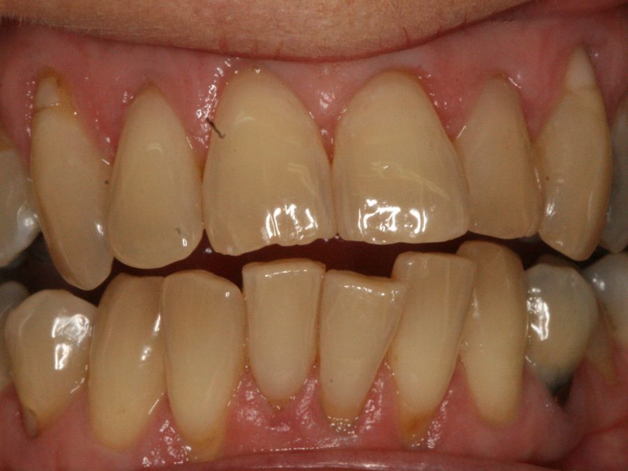 Before same-day restoration